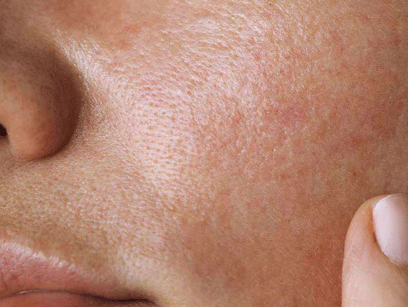 مراقبت پوست چرب