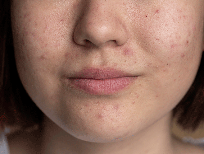 کرم ضدآکنه ایرانی