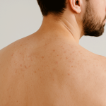 بررسی اسپری ضد جوش سبوما آردن