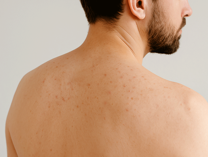 بررسی اسپری ضد جوش سبوما آردن