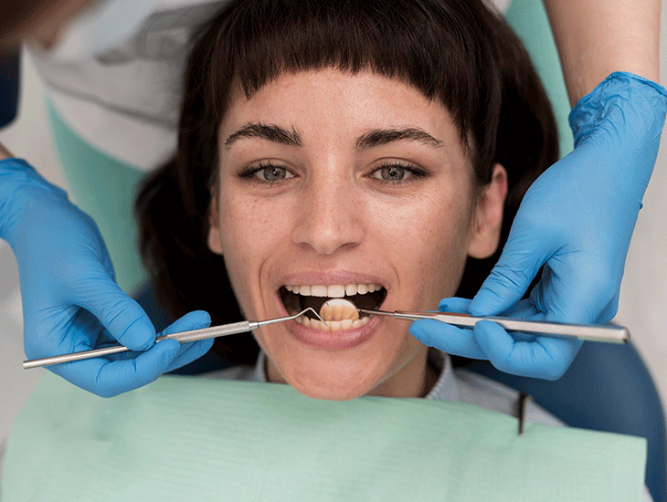 مراقبت‌های بعد کامپوزیت