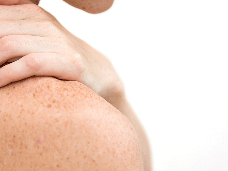 مراقبت بدن آکنهای